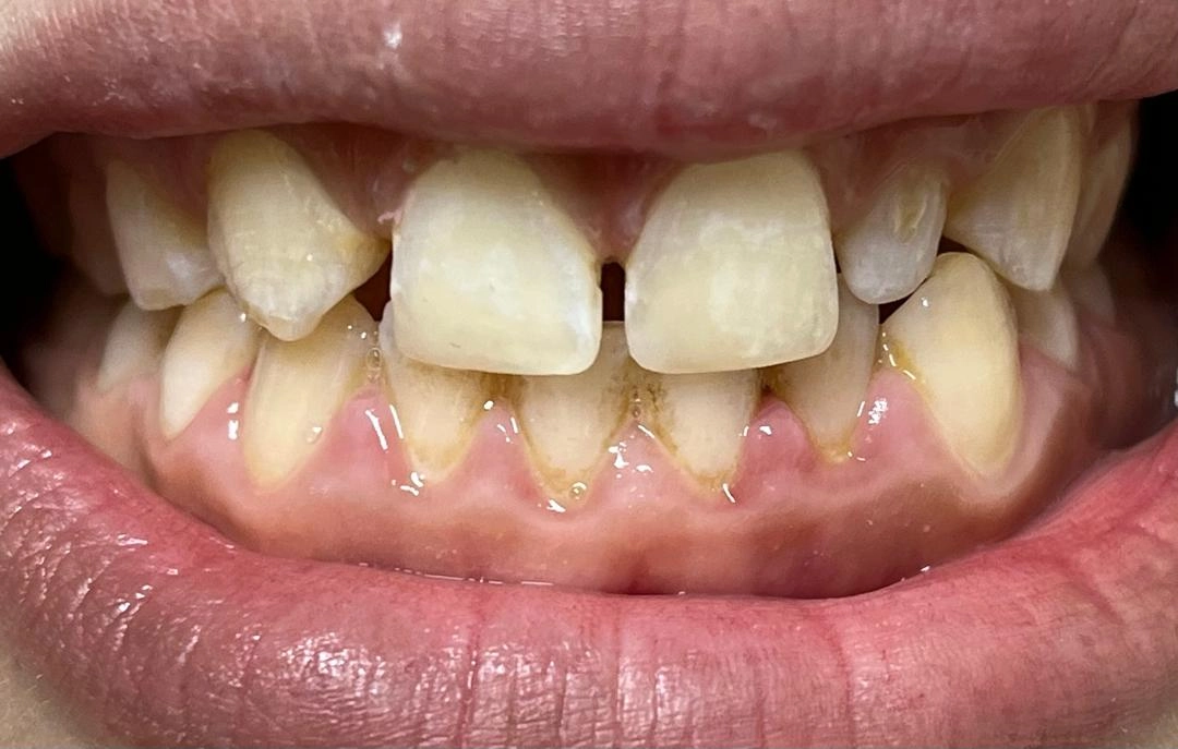 Avant traitement soins dentaires BioDental Annaba